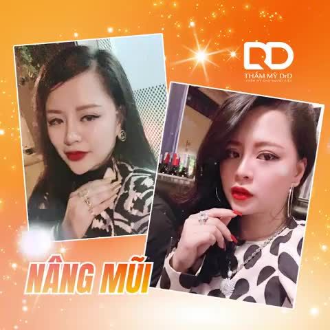 Cùng nhìn lại hình ảnh trước và sau Nâng mũi + Độn cằm của khách hàng DrD nhé!